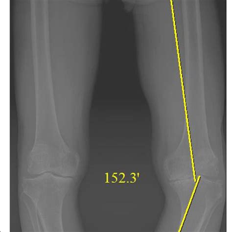 Preoperative Long Standing Anteroposterior Radiograph Of A Patient With Download Scientific