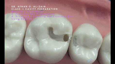 Class I Cavity Preparation For Amalgam Mandibular Molar Off