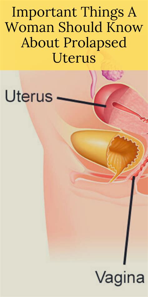 Important Things A Woman Should Know About Prolapsed Uterus Prolapsed