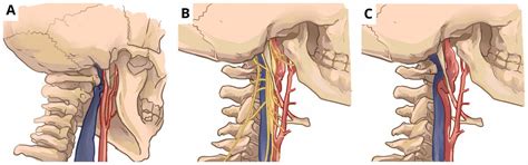 Stylohyoid Eagle Syndrome And EXTracranial INternal Carotid ArTery