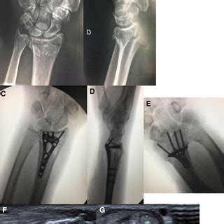 Preoperative A B And Postoperative Anterior To Posterior C