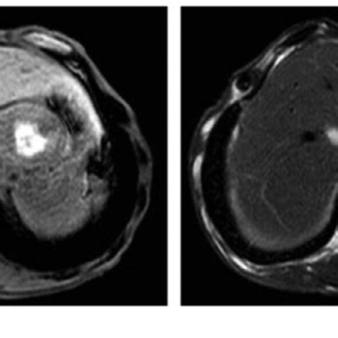 Magnetic Resonance Imaging Mri A T1 Weighted Mri Showed A