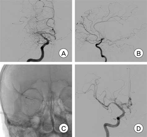 A Anterior Posterior View Of Right Internal Carotid Angiogram Shows Download Scientific