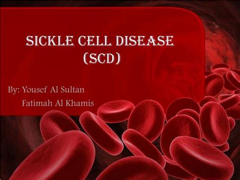 PPT SICKLE CELL DISEASE Scd PowerPoint Presentation Free