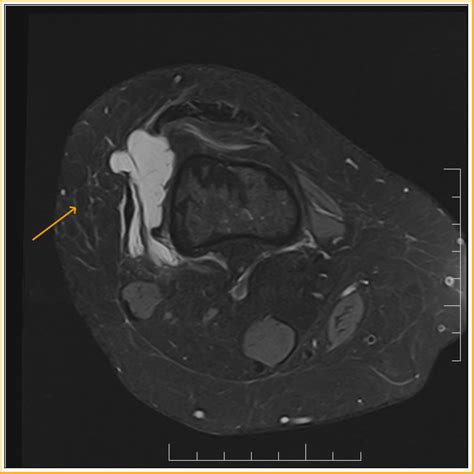 Iliotibial Band Syndrome Mri Sumer S Radiology Blog