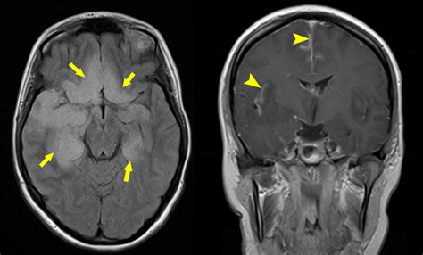 Herpes Simplex Encephalitis Radiology At St Vincent S University