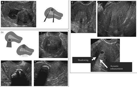 Terms Definitions And Measurements To Describe The Sonographic Hot