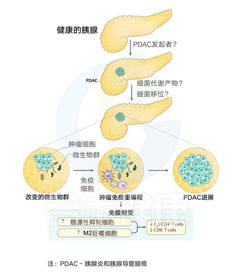 微生物，或许是下一个癌中之王（胰腺癌）诊断和干预治疗的新出路胰腺癌微生物干预微生物群肠道细胞炎症 健康界