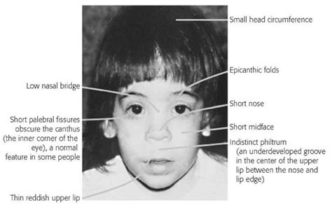 Fetal Alcohol Syndrome Pictures Figure 6 Facial Features Associated With The Fetal Alcohol