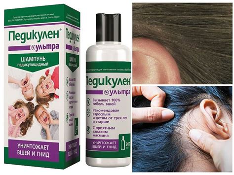 Шампуни от вшей и гнид для детей за один раз