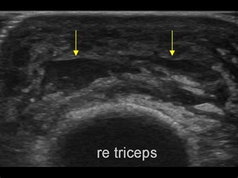 Musculoskeletal Joints and Tendons | 6.2 Elbow : Case 6.2.5 Olecranon bursa and triceps tendon ...