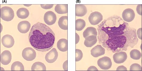 Deciphering The Role Of Monocyte And Monocyte Distribution Width Mdw