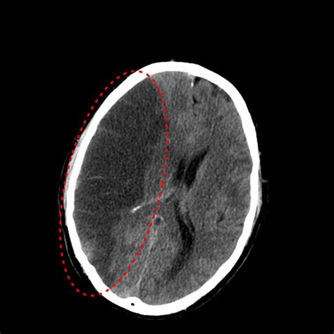 Ischemická CMP CT Medicína nemoci studium na 1 LF UK