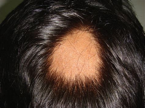 Alopecia Areata An Update Indian Journal Of Dermatology Venereology And Leprology