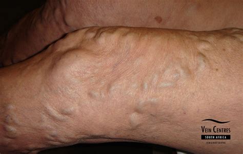 Pregnancy After Varicose Vein Treatment - Pregnancy & Birth