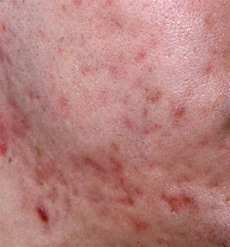 Acne Vulgaris Icd 10 L70 Online Consultation Ai Dermatologist