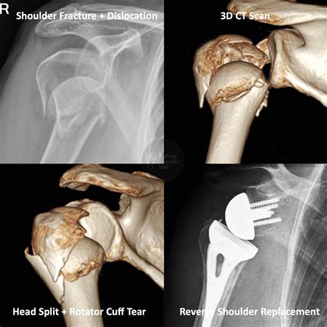 Shoulder Fracture With Dislocation Medical Case Study Sydney