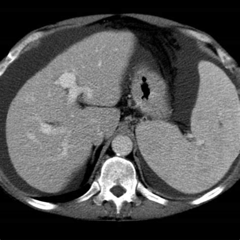 Nodular Regenerative Hyperplasia Radiology Key