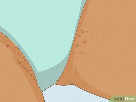 How To Get Rid Of Razor Bumps In The Bikini Area Easy Tips