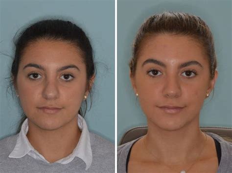 Rhinoplasty Photos Miami Fl Patient 717