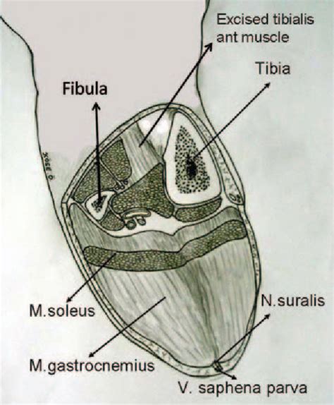 Figure 2 From A Novel Technique For Transtibial Amputation In Chronic Occlusive Arterial Disease