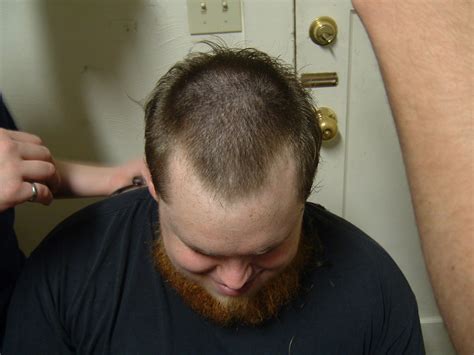 Horseshoe Pattern Baldness