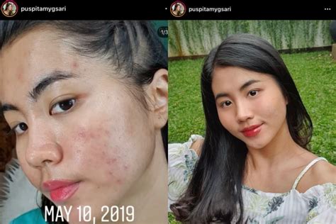 Female Daily Editorial Inspiratif Ini 6 Influencer Acne Fighter Yang