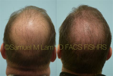 Dallas Finasteride And Minoxidil Before And After Photos Plano Plastic Surgery Photo Gallery