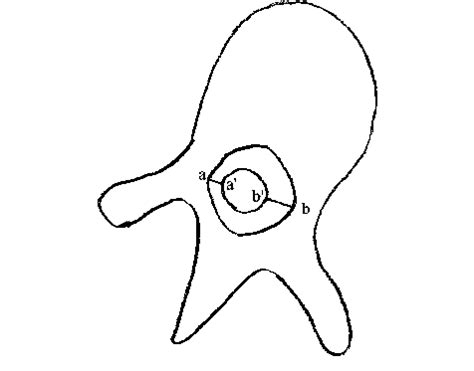 Illustration Of A Thoracic Vertebra With The Measurements Of Epidural