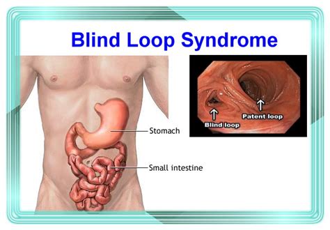 Blind loop syndrome - Sure Developers Team