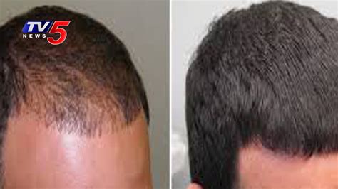 Latest Hair Regrowth Treatments And Hair Loss Solutions Vibes Tv5