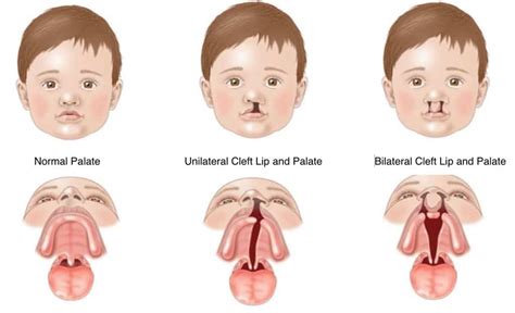 Cleft Lippalate And Craniofacial Anomalies In Ne Calgary