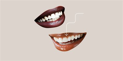 What Do Long Canine Teeth Mean
