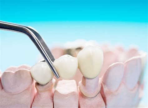 Porcelain Fixed Bridges Seal Beach Gentle Care Dental Center