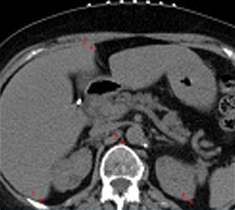 Abdominal Masses Sampled At Petct Guided Percutaneous Biopsy Initial