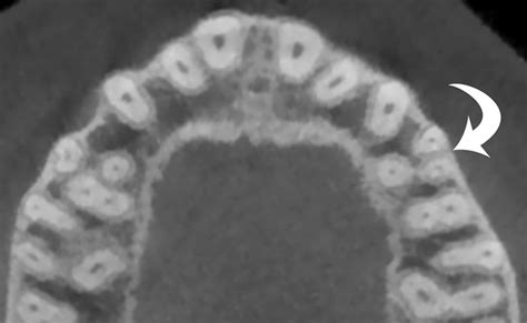 Axial Cbct Image Showing A Unilateral Three Rooted Mfp On The Left Side