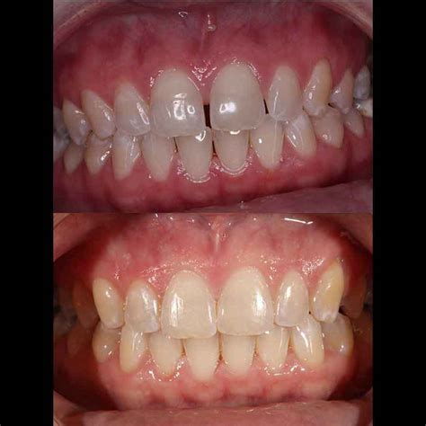 Clear Braces For Teeth Before And After