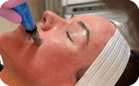 The Ultimate Guide To Microneedling Face Treatment Benefits Process