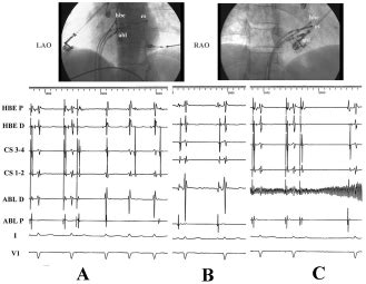 Slow Pathway Ablation In A Patient With An Abnormal Atrioventricular