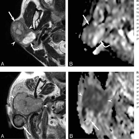 Figure 2 From Carcinoma Ex Pleomorphic Adenoma Of The Parotid Gland Radiologic Pathologic