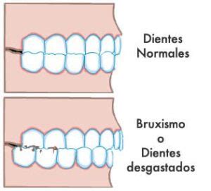 Bruxismo Tratamiento Y Causas