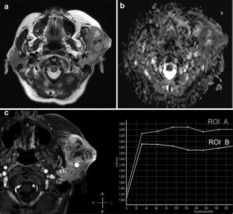 Mri Findings A Axial T2 Weighted Mr Image Shows The Intermediate Download Scientific Diagram