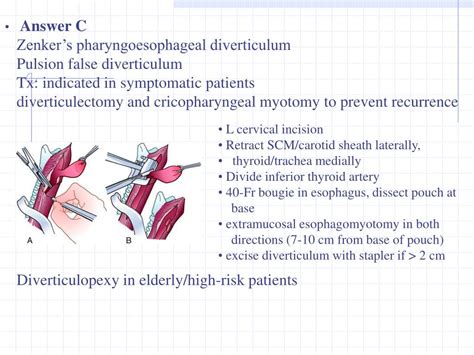 Ppt A Diverticulectomy And Myotomy B Myotomy Alone C