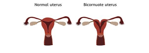 Heart shaped uterus: symptoms, causes, consequences on fertility