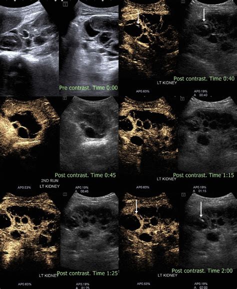 Complex Renal Cyst Noncontrast Ultrasound Shows A Large Renal Cyst