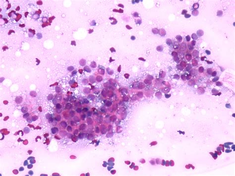 Benign Nodular Hyperplasia