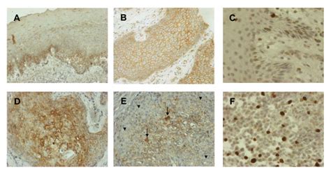 Immunohistochemical Staining Of Egfr Catenin And Cyclin D In Oral