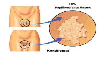 Kenapa Muncul Daging Atau Kutil Di Kemaluan Dan Bagaimana