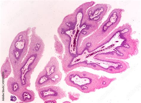 Squamous Papillomas Of The Mouth And Throat Including Tongue Tonsil