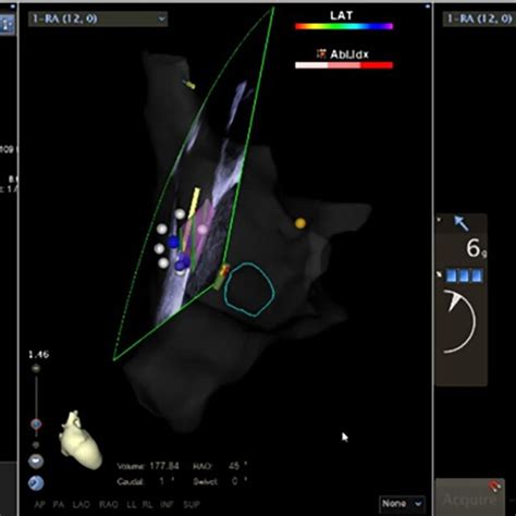 Intracardiac Echocardiography Ice Was Performed To Confirm The